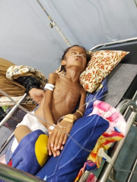 Haji Uma Tanggung Biaya Pendamping Untuk Naisya Alfaiza Yang Menderita Gizi Buruk Di Aceh Utara