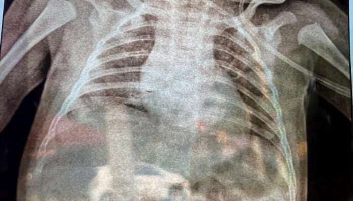 Bayi Di Peunaga Cut Ujong Alami Gangguan Pernapasan Yang Diduga Akibat Debu Batubara